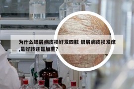 为什么银屑病皮损好发四肢 银屑病皮损发痒,是好转还是加重?