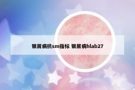 银屑病抗sm指标 银屑病hlab27