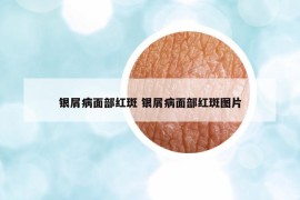 银屑病面部红斑 银屑病面部红斑图片