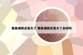 银屑病斑点变大了 银屑病斑点变大了会好吗