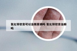 氧化锌软膏可以治银屑病吗 氧化锌软膏治癣吗