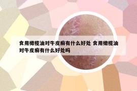 食用橄榄油对牛皮癣有什么好处 食用橄榄油对牛皮癣有什么好处吗
