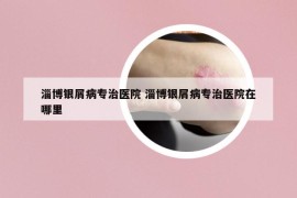 淄博银屑病专治医院 淄博银屑病专治医院在哪里