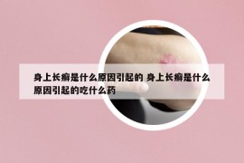身上长癣是什么原因引起的 身上长癣是什么原因引起的吃什么药