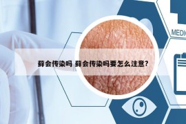 藓会传染吗 藓会传染吗要怎么注意?