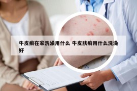 牛皮癣在家洗澡用什么 牛皮肤癣用什么洗澡好