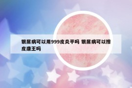 银屑病可以用999皮炎平吗 银屑病可以擦皮康王吗