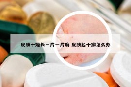 皮肤干燥长一片一片癣 皮肤起干癣怎么办