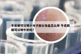 牛皮癣可以喝小分子肽化妆品怎么样 牛皮肤癣可以喝牛奶吗?