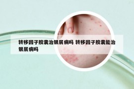 转移因子胶囊治银屑病吗 转移因子胶囊能治银屑病吗
