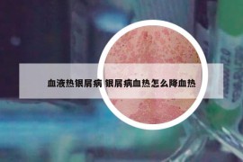 血液热银屑病 银屑病血热怎么降血热