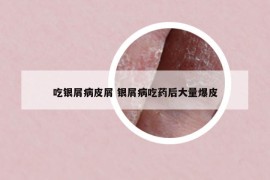 吃银屑病皮屑 银屑病吃药后大量爆皮