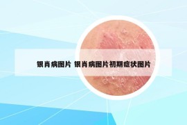 银肖病图片 银肖病图片初期症状图片