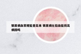 银屑病血常规能查出来 银屑病化验血能找出病因吗