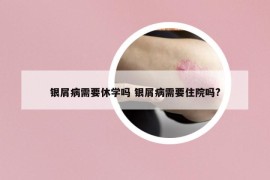 银屑病需要休学吗 银屑病需要住院吗?
