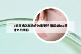 b银屑病怎样治疗效果更好 银屑病bsa是什么的简称