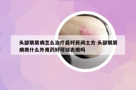 头部银屑病怎么治疗最好民间土方 头部银屑病用什么外用药好可以去根吗