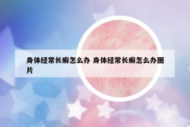 身体经常长癣怎么办 身体经常长癣怎么办图片