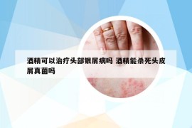 酒精可以治疗头部银屑病吗 酒精能杀死头皮屑真菌吗