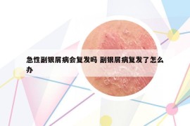 急性副银屑病会复发吗 副银屑病复发了怎么办