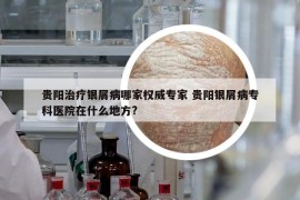 贵阳治疗银屑病哪家权威专家 贵阳银屑病专科医院在什么地方?