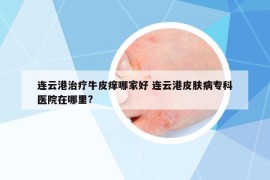 连云港治疗牛皮痒哪家好 连云港皮肤病专科医院在哪里?
