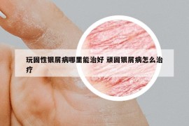 玩固性银屑病哪里能治好 顽固银屑病怎么治疗