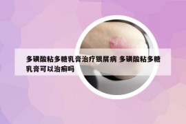 多磺酸粘多糖乳膏治疗银屑病 多磺酸粘多糖乳膏可以治癣吗