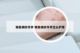 银屑病秋冬季 银屑病秋冬季怎么护理