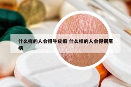 什么样的人会得牛皮癣 什么样的人会得银屑病