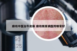 廊坊中医治牛皮癣 廊坊银屑病医院哪家好