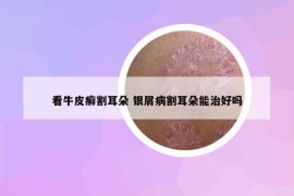 看牛皮癣割耳朵 银屑病割耳朵能治好吗