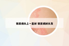 银屑病头上一直掉 银屑病掉头发