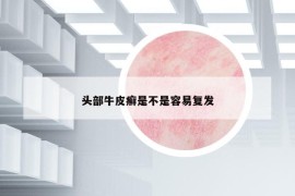 头部牛皮癣是不是容易复发