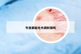 牛皮癣能吃大调料饭吗