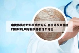 扁桃体摘除后银屑病会好吗 扁桃体发炎引起的银屑病,切除扁桃体有什么危害