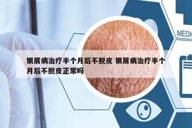 银屑病治疗半个月后不脱皮 银屑病治疗半个月后不脱皮正常吗