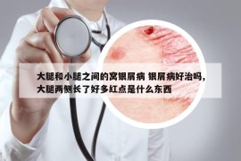 大腿和小腿之间的窝银屑病 银屑病好治吗,大腿两侧长了好多红点是什么东西