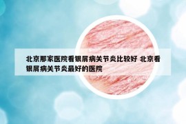 北京那家医院看银屑病关节炎比较好 北京看银屑病关节炎最好的医院