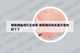 银屑病连成片无皮屑 银屑病没有皮是不是快好了了