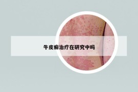 牛皮癣治疗在研究中吗