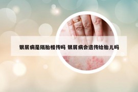 银屑病是隔胎相传吗 银屑病会遗传给胎儿吗