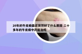 20年的牛皮癣最近突然好了什么原因 二十多年的牛皮癣中药能治吗