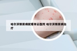 哈尔滨银屑病就看祥云医院 哈尔滨银屑病治疗