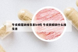 牛皮癣是缺维生素k4吗 牛皮肤癣缺什么维生素