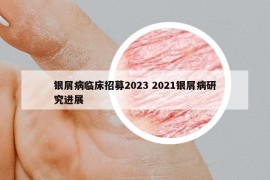 银屑病临床招募2023 2021银屑病研究进展