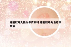 连翘败毒丸能治牛皮癣吗 连翘败毒丸治疗银屑病