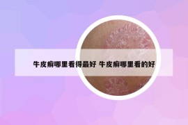 牛皮癣哪里看得最好 牛皮癣哪里看的好