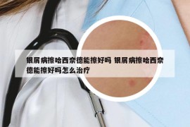 银屑病擦哈西奈德能擦好吗 银屑病擦哈西奈德能擦好吗怎么治疗
