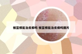 板蓝根能治皮癣吗 板蓝根能治皮癣吗图片